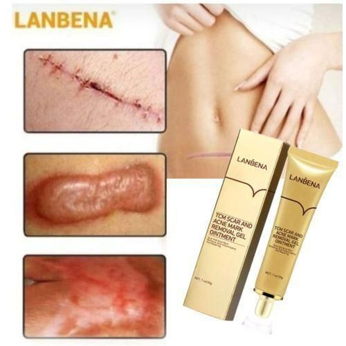 Lanbena Acne Scar Stretch Marks Keloids Pimples Black Dark Spots Remover Burns Treatment Skin Care And Repair Gel Cream 30g